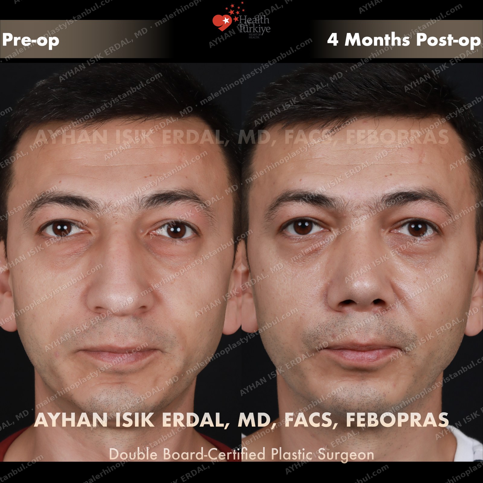 Male rhinoplasty before and after — frontal view, Case 1