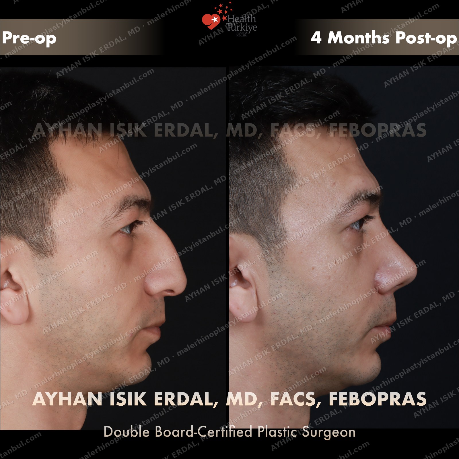 Male rhinoplasty before and after — profile view, Case 1