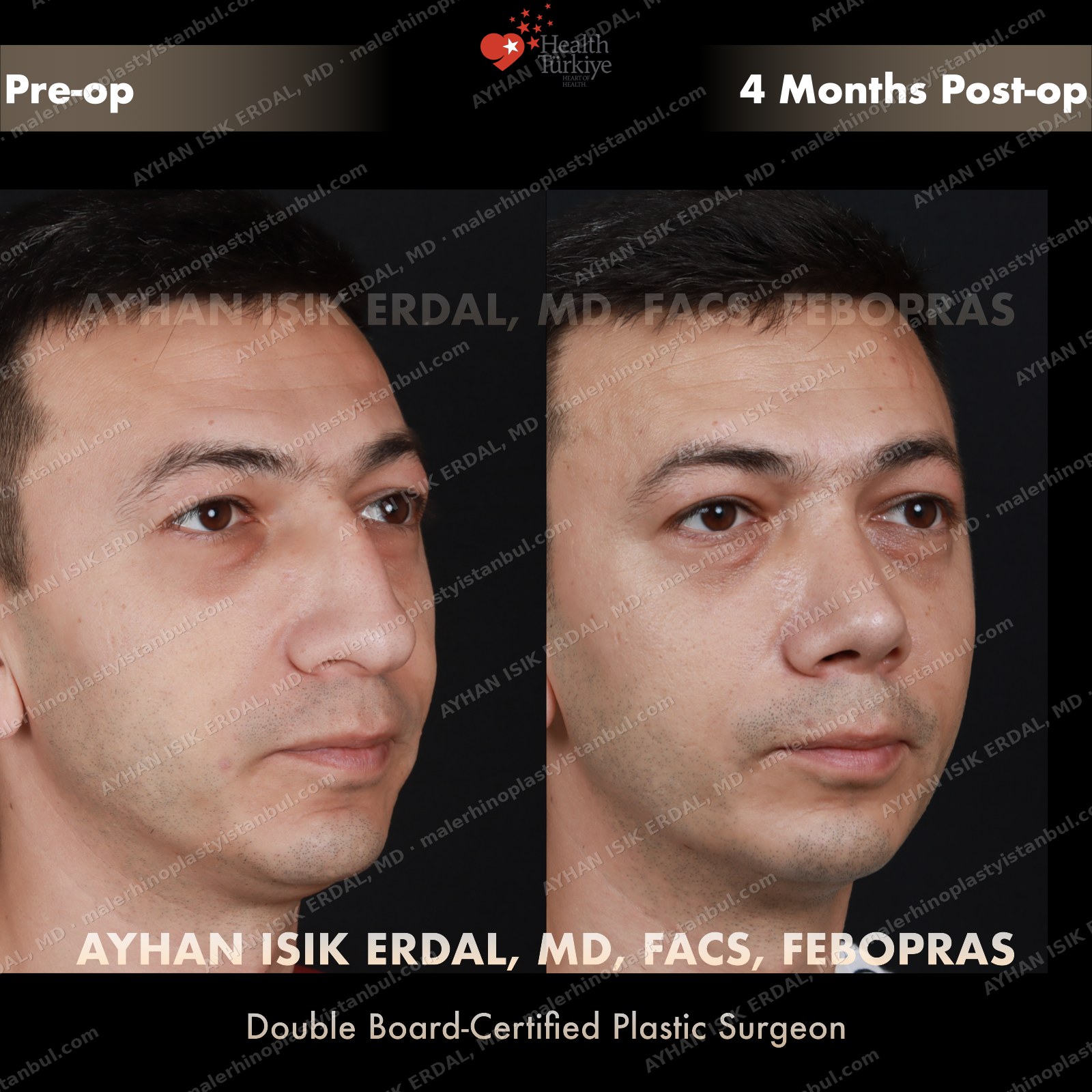 Male rhinoplasty before and after — opposite profile, Case 1