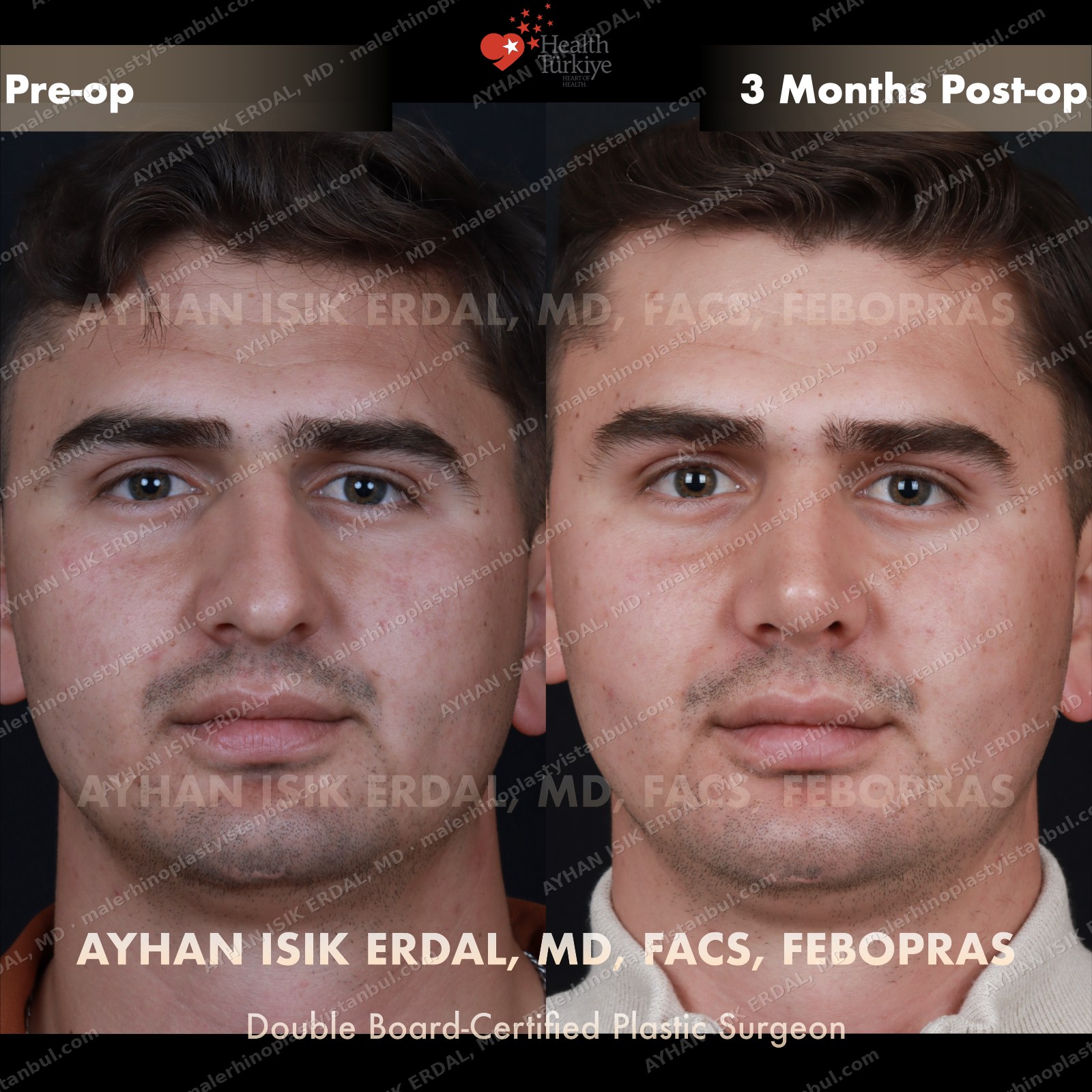 Male rhinoplasty before and after — frontal view, Case 2