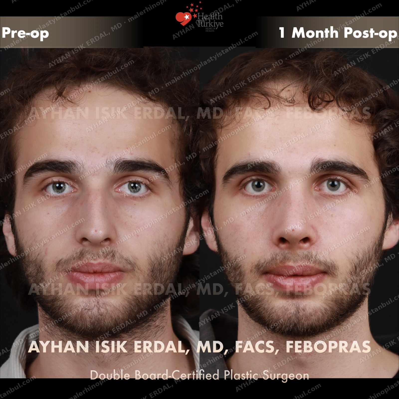 Male rhinoplasty before and after — frontal, Case 3