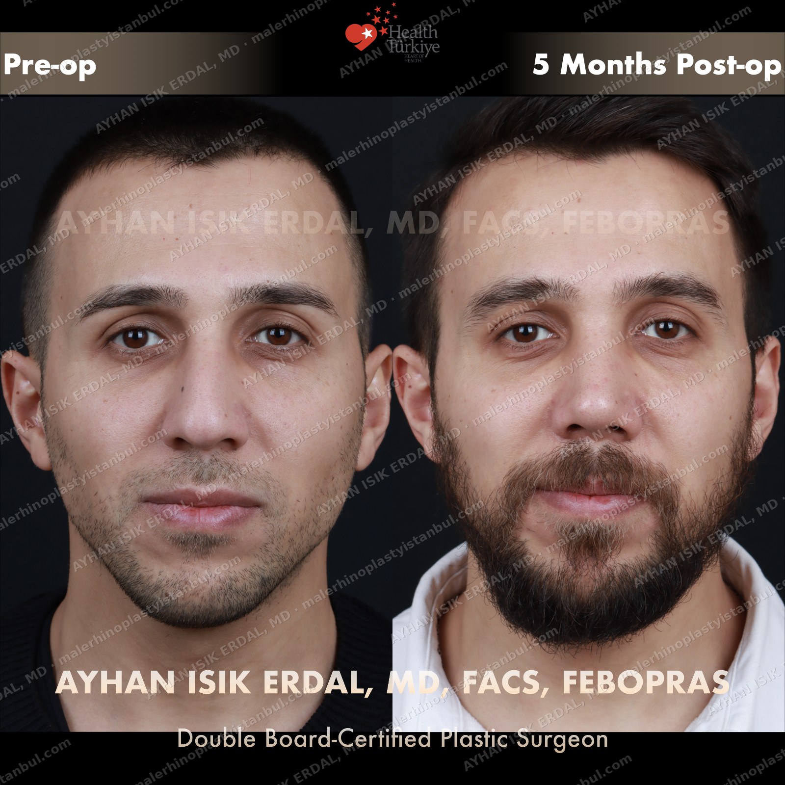 Male rhinoplasty before and after — frontal, Case 4