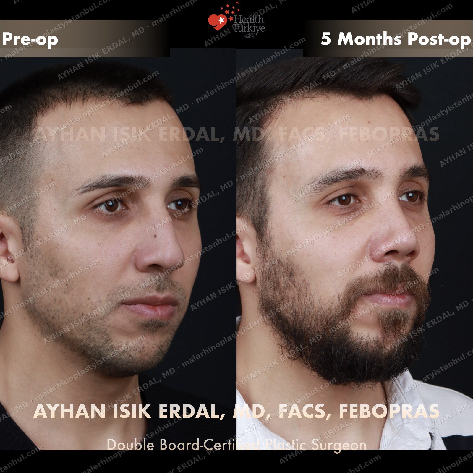 Male rhinoplasty before and after — three-quarter, Case 4