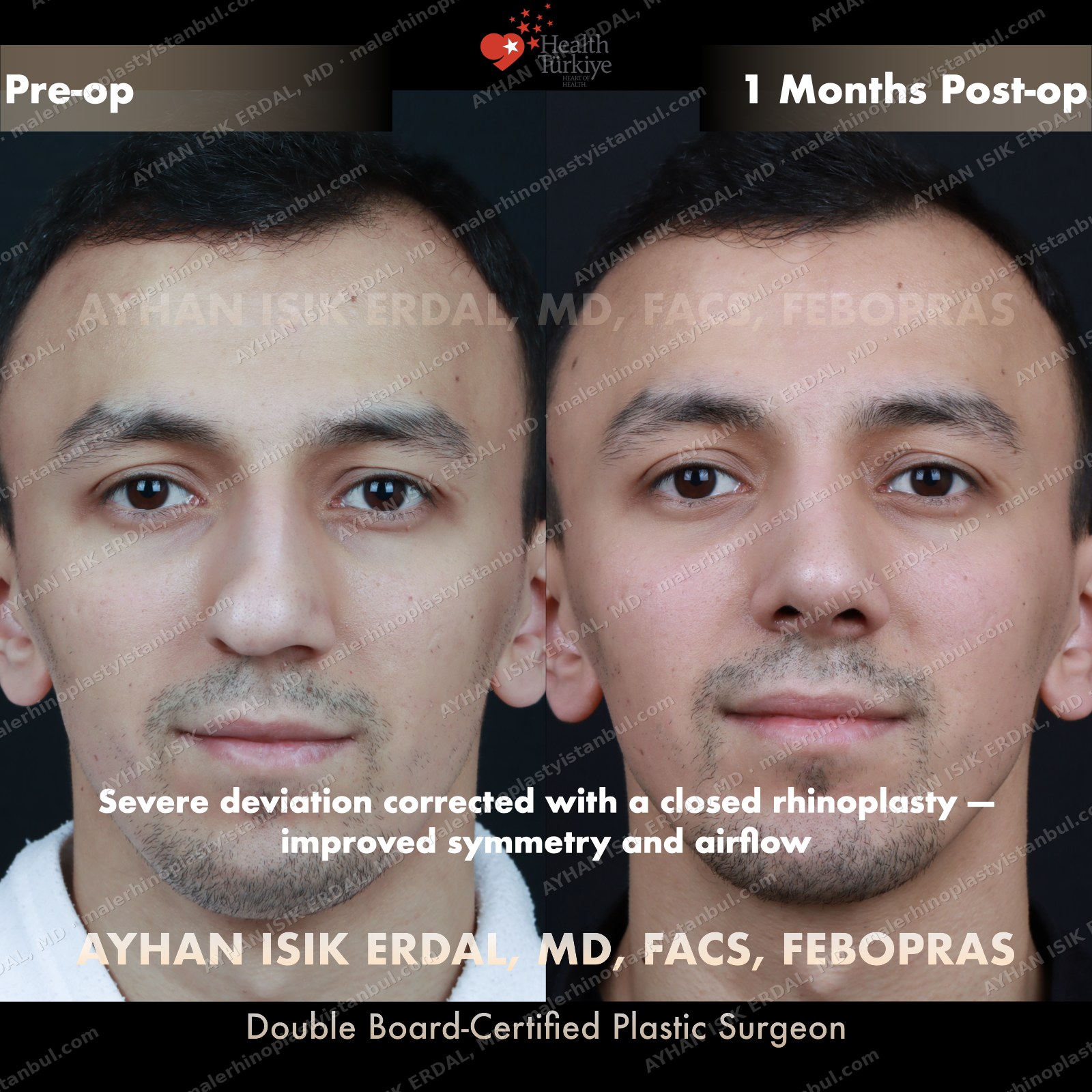 Male closed septorhinoplasty before and after — frontal showing severe deviation correction, Case 5