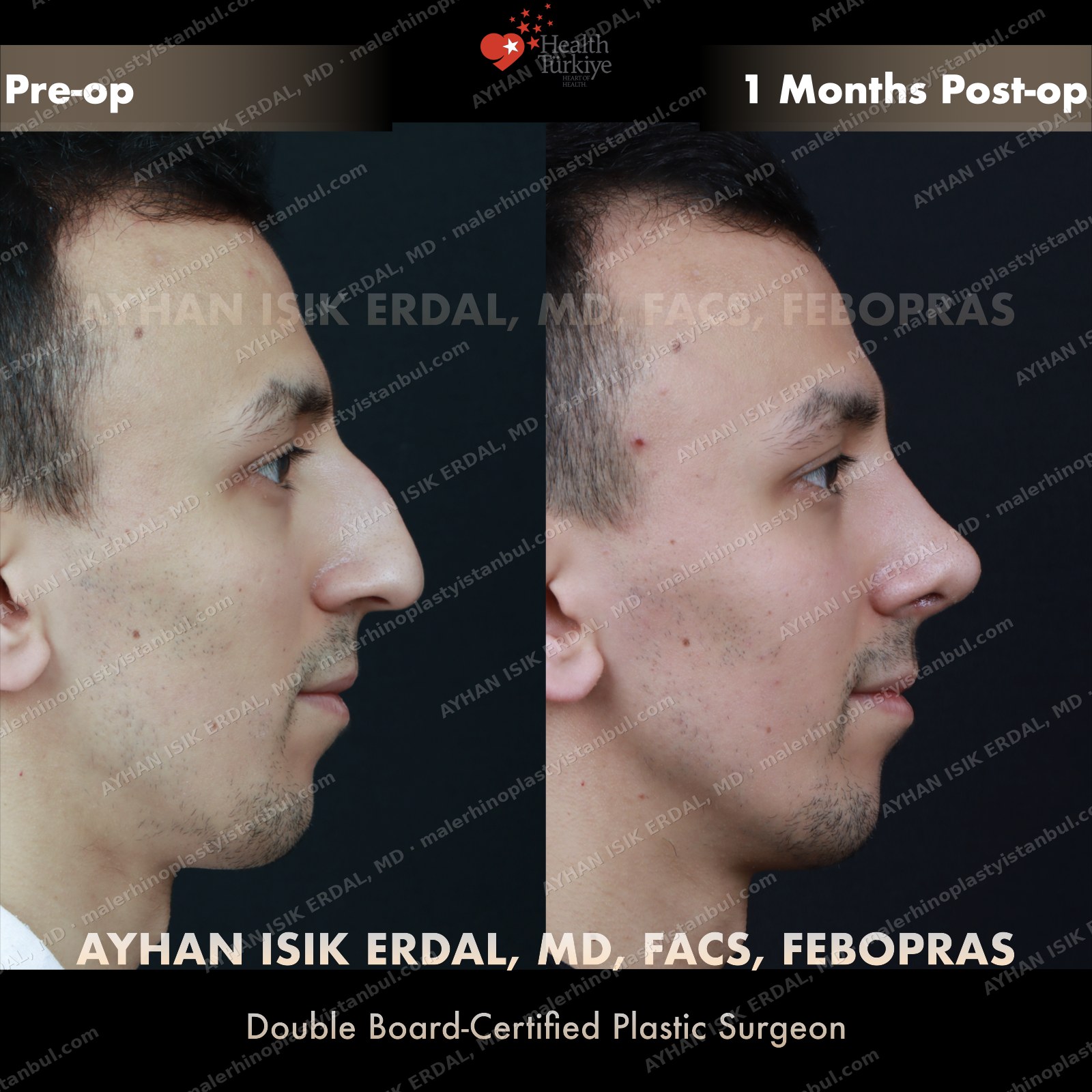 Male closed septorhinoplasty before and after — three-quarter, Case 5