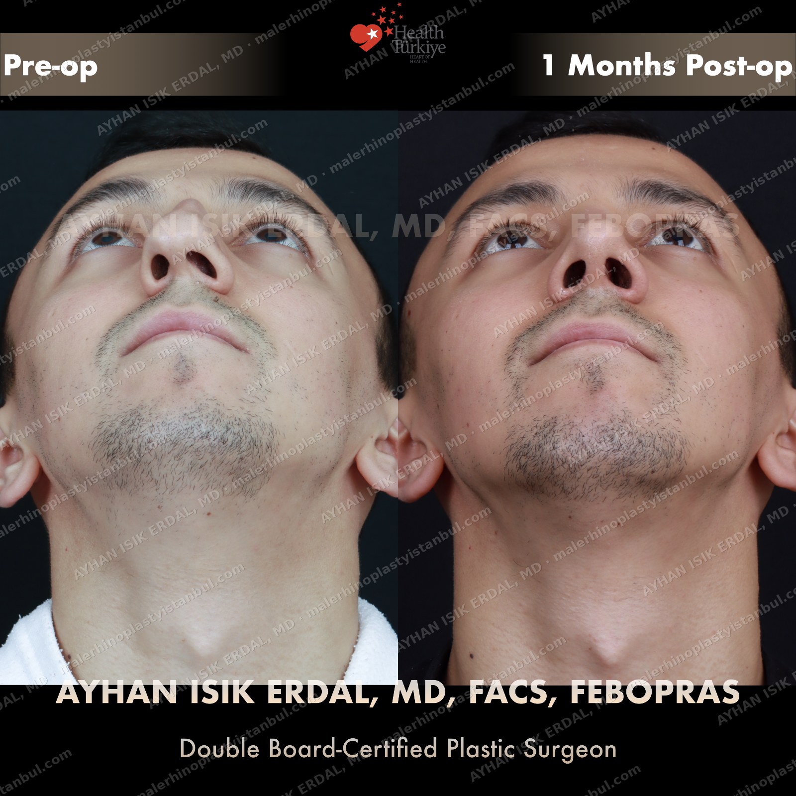 Male closed septorhinoplasty before and after — basal view showing restored symmetry, Case 5